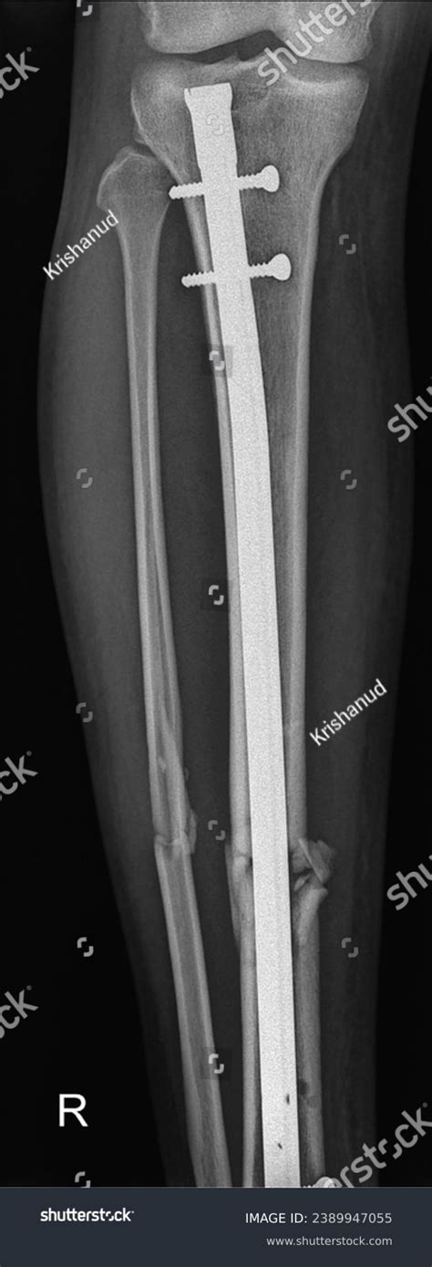 Intramedullary Nail Tibia 的图像结果