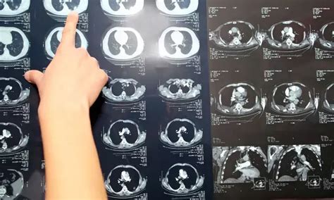 FlowTriever System benefits pulmonary embolism patients both clinically ...