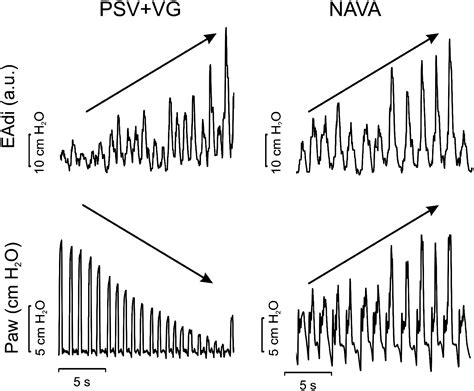 Proportional Assist Ventilation and Neurally Adjusted Ventilatory ...