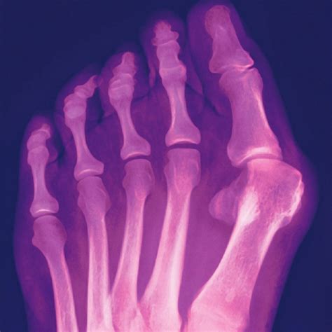 Colac Podiatrist, Danny Hegarty, answers ‘how do you treat bunions?’ - Prosper Health Group