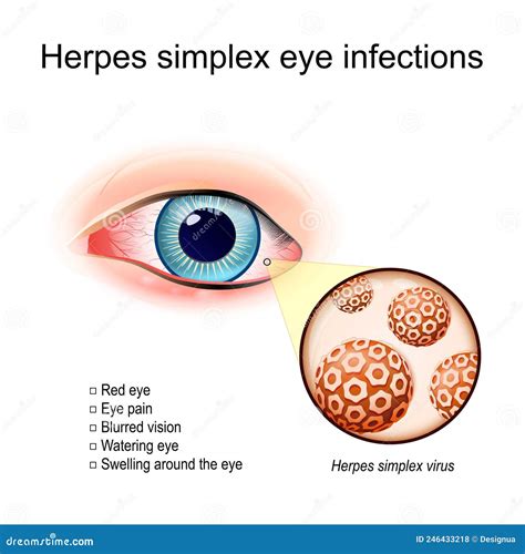 Herpes Simplex Under Eye