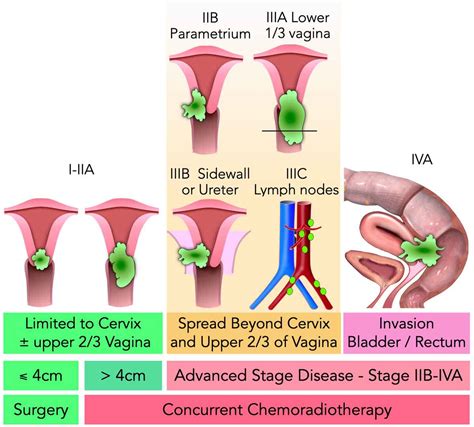 Cervical Cancer Cell Stages Types Of Cervical Cancer | Stages Of