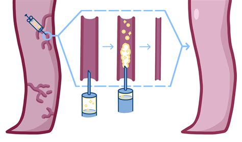 Sclerotherapy - Delaware Vein Center