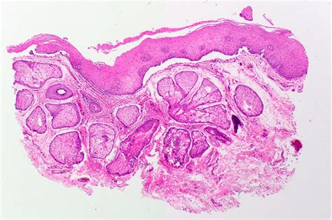 Fordyce Granules Histology