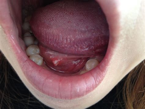 舌頭長一顆紅色 – Portogal