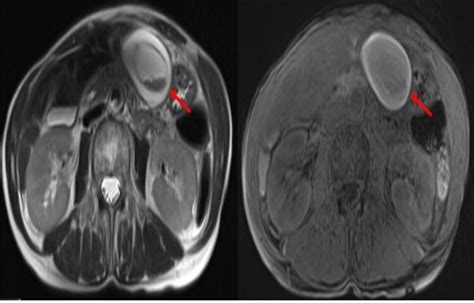 Image result for Abnormal MRCP