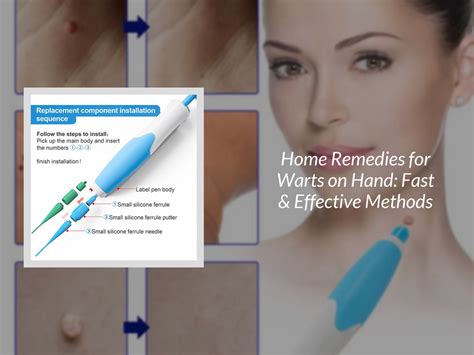 Home Remedies for Warts on Hand: Fast & Effective Methods - KentDO ...
