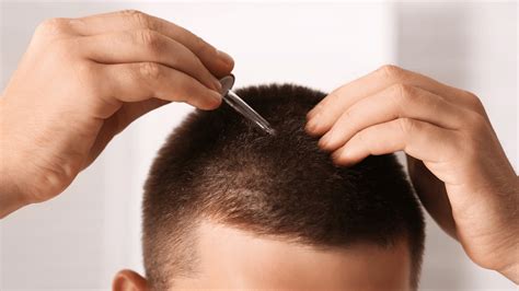 Hairline Growth Tips: Know How to Stop Receding Hairline