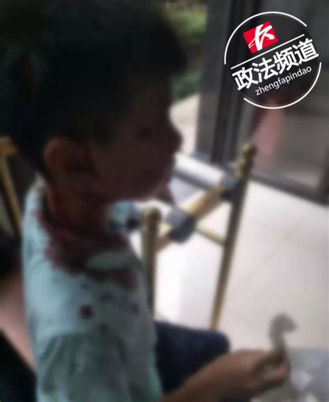 长沙10岁男童小区内玩耍遭大型犬撕咬 头部脸部多处受伤！_都市_长沙社区通