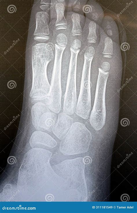 Xray Normal Foot X Ray Normal Human S Foot Lateral Stock Photo Image