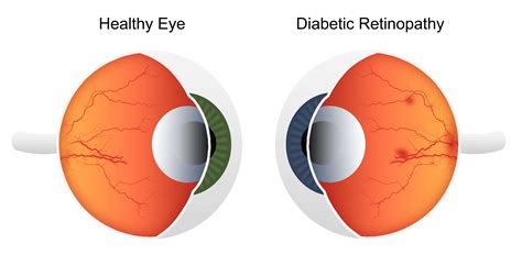 Does Diabetes Affect Eyesight