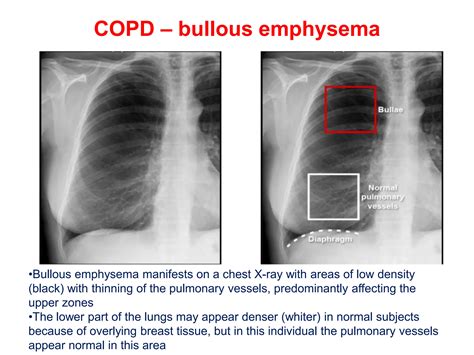 CHEST X-RAY PULMONARY DISEASE pptx.pptx