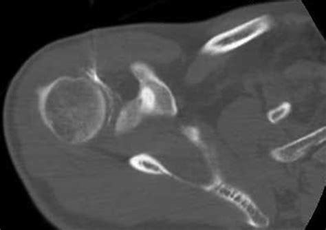 CT-Guided Shoulder Arthrography at the Rotator Cuff Interval | AJR