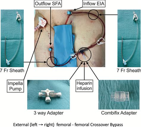 Temporary Extracorporeal Femoro-Femoral Crossover Bypass to Treat Acute ...