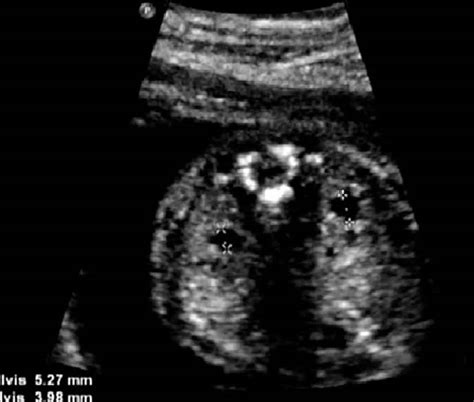 Pyelectasis, fetal pyelectasis, causes, treatment & prognosis