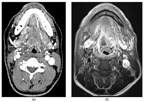 Role of PET/CT in Oropharyngeal Cancers