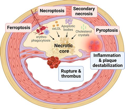 Regulated Necrosis in Atherosclerosis | Arteriosclerosis, Thrombosis ...