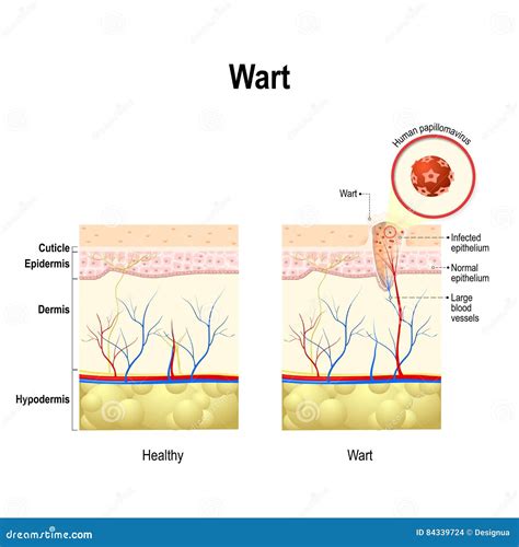 The Structure Of The Wart. The Structure Of The Skin. Infographics ...