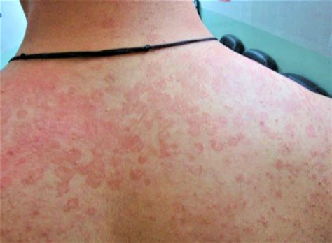 Tinea Versicolor - Causes, Signs, Symptoms, Treatment & Remedies