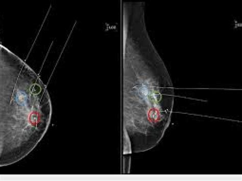 Wire Localization Procedure 的图像结果