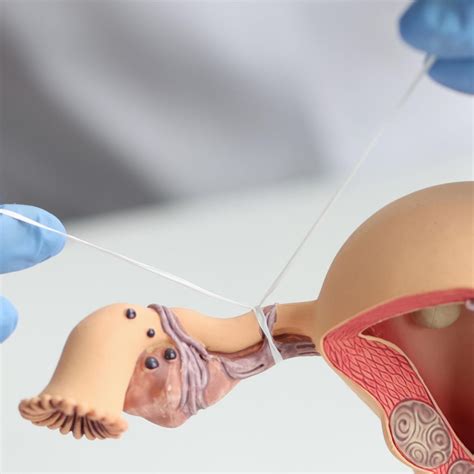 La esterilización: ligadura de trompas y vasectomía – Iqui.ec – Clínica de fertilidad en Quito ...