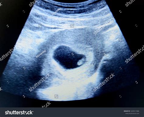 Fetus At 7 Weeks Ultrasound