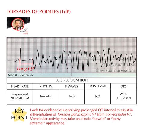 Torsades de Pointes (TdP) on the ECG for nurses & nursing students — The Visual Nurse