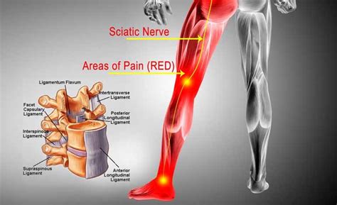 Sciatica