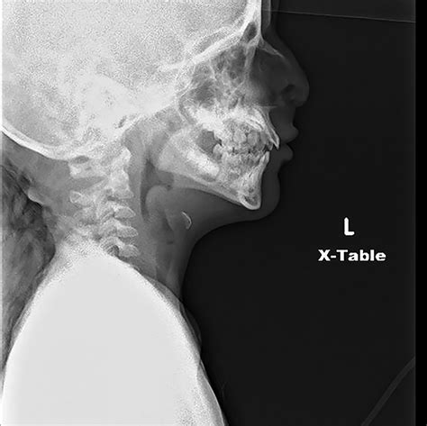 Thumb Sign Epiglottitis