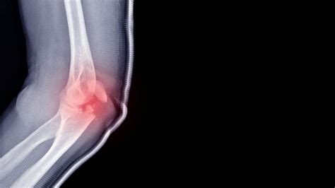 Adult Elbow Fractures - Physioflow PT | Physical Therapy | Vancouver, WA
