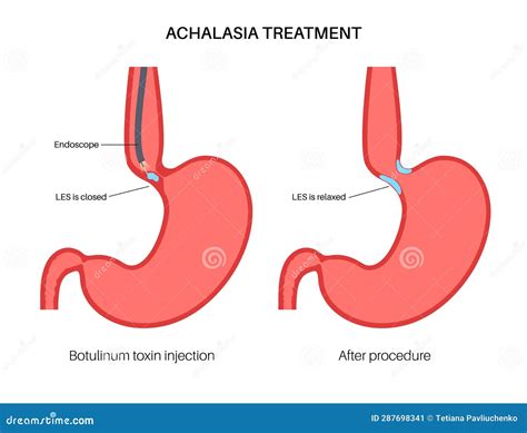 Esophageal Botulinum Toxin Injection Stock Vector - Illustration of ...