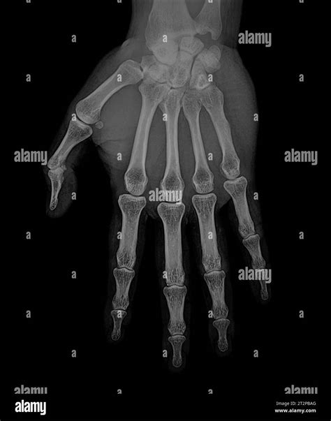 Healthy hand, X-ray Stock Photo - Alamy