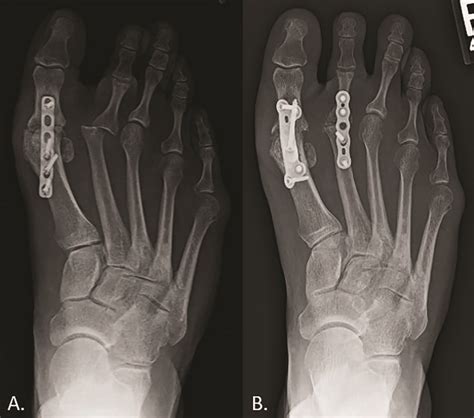Metatarsal Head Resection