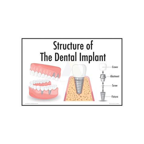 Anne Print Solutions® Structure of Dental Implants Chart Poster, 13 x ...