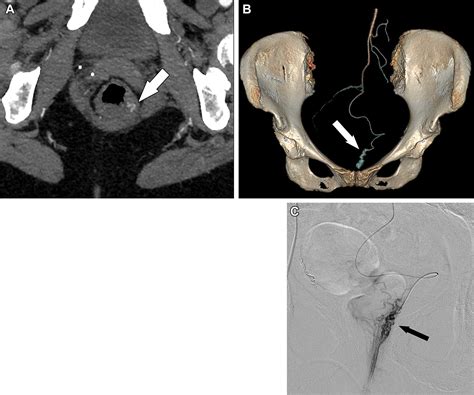 Rectal Artery Embolization for Hemorrhoidal Disease: Anatomy, Evaluation, and Treatment ...