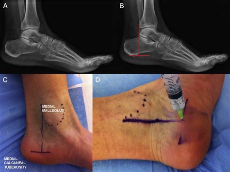 Steroid Injection For Plantar Fasciitis Treatment at Mary Bevis blog