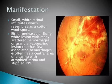 Hiv retinopathy | PPTX