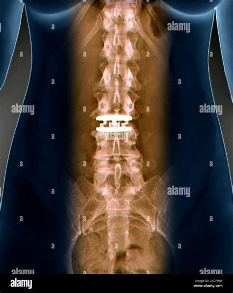Artificial spinal disc. Coloured X-ray of the spine of a 42 year old ...