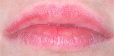 Lips Red And Burning And Chapped - Lippard Blog