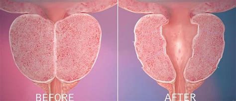 Image result for Problems After UroLift