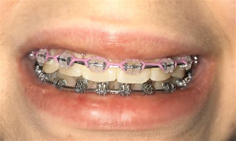 i was supposed to get my braces off this summer after 4 years 😢😢 : r/braces