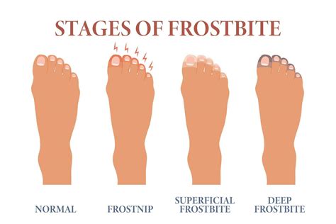 Frozen toes. Stages of frostbite of fingers. Healthcare and medicine ...