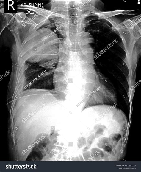 Pneumothorax On Icd Chest X Ray Stock Photo 2257465709 | Shutterstock
