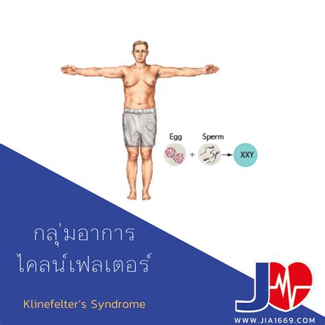 Sindrome Xxy Abnormalities And Diseases Present In 47,XYY Males (32,