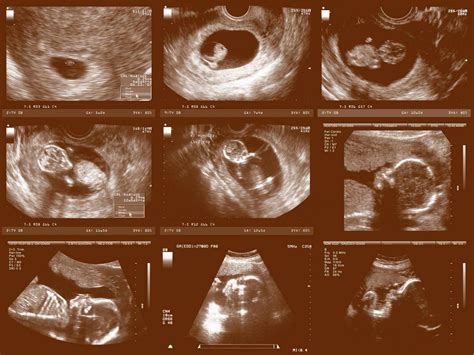 Ultrasonography Vs Ultrasound Obstetric Ultrasound Diagnostic