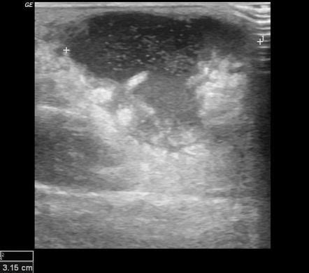 Image result for Axillary Abscess