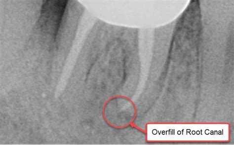 What happens if root canal fails? - Dental News Network