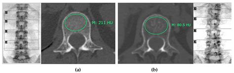 Opportunistic Screening for Osteoporosis by CT as Compared with DXA