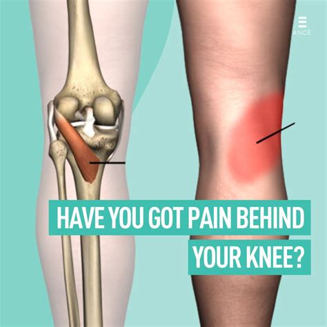 Pain behind the knee is often attributed to the popliteus muscle, a small triangular muscle ... - muscle pain behind knee