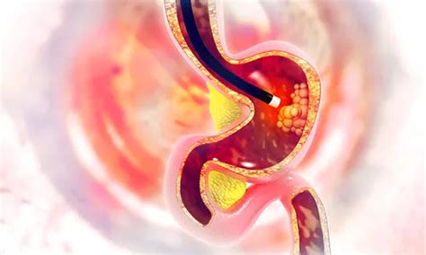 Intestinal Cancer: Symptoms, Diagnosis, Treatment, and Risk Factors | MOC